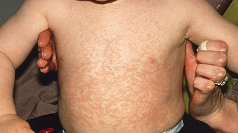 На фона на нарастващ брой случаи на морбили дребна шарка в