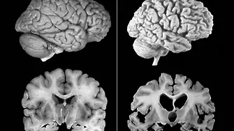 Ново лекарство за Алцхаймер показва впечатляващи резултати