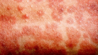 Налице е непосредствена глобална заплаха от разпространение на морбили в