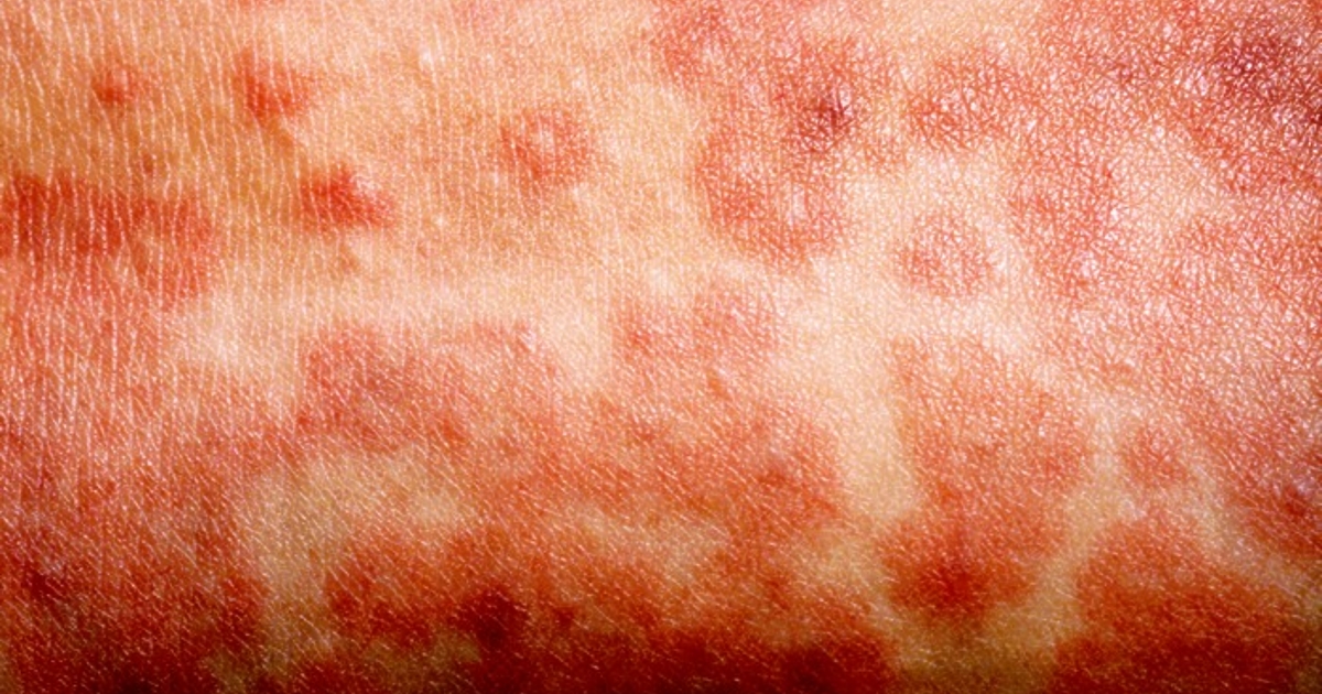 Налице е непосредствена глобална заплаха от разпространение на морбили в