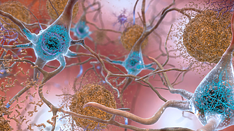 Изследване: Ново лекарство забавя развитието на болестта на Алцхаймер