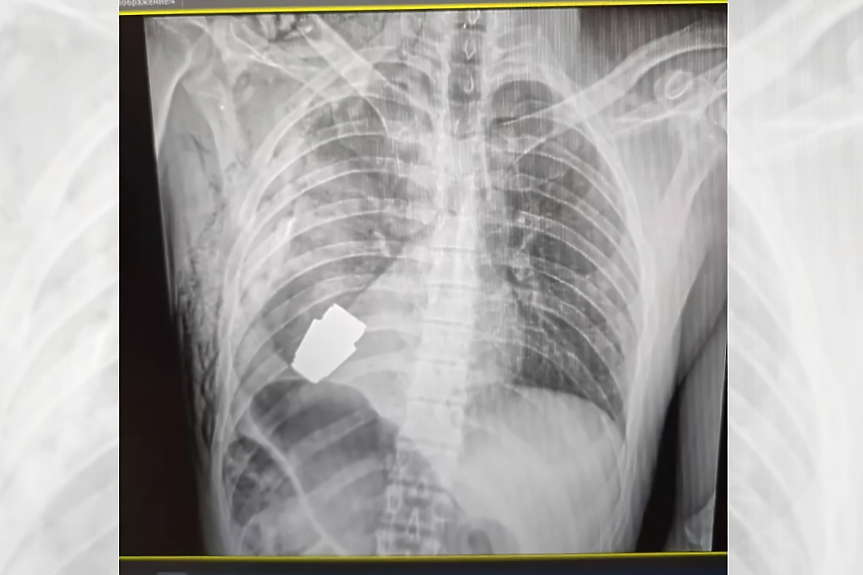 Неизбухнала граната в гърдите? Потърси украински хирурзи и сапьори