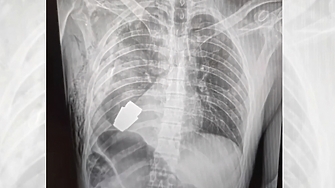 Украински военни лекари са провели рядка и изключително опасна операция