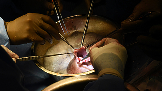 Хирурзи отново пробваха с трансплантация на свинско сърце на човек