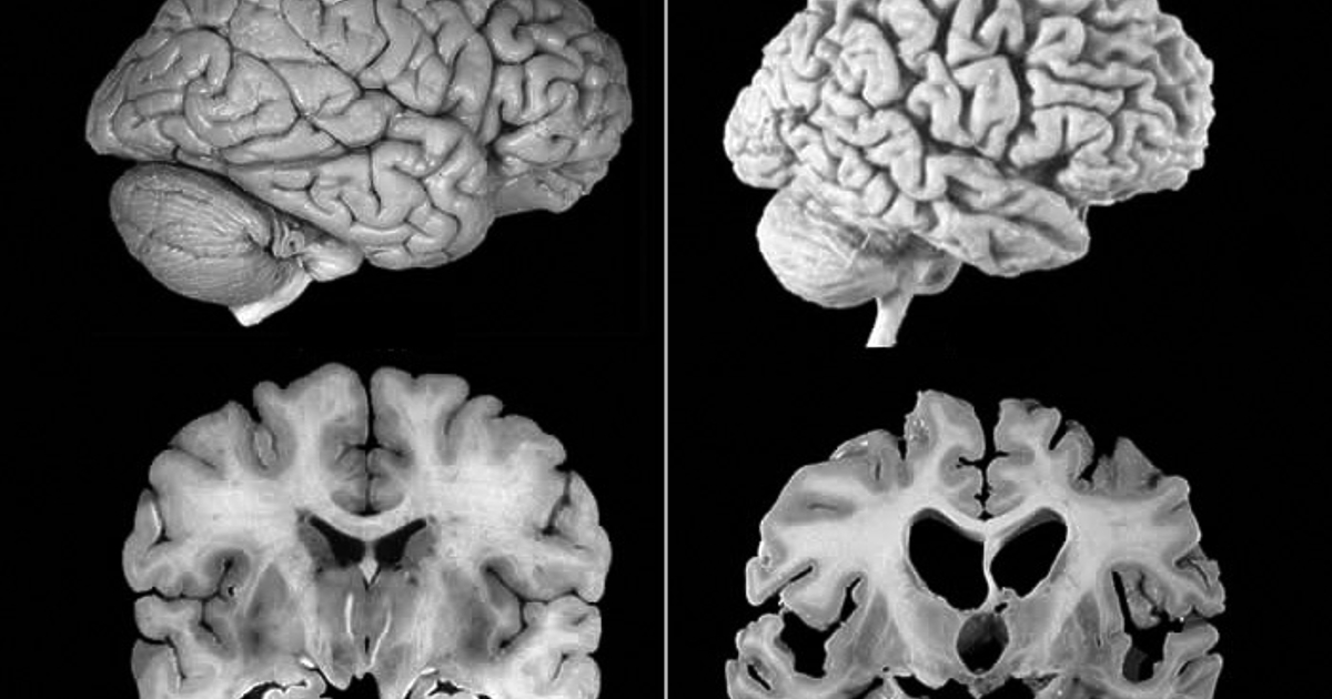 Болестта на Алцхаймер е най-разпространената форма на деменция в световен